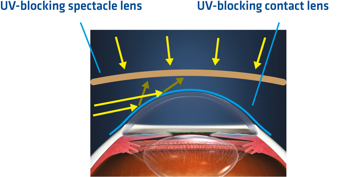 Sunglasses plus UV-blocking contact lenses